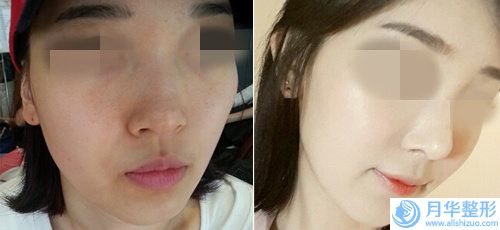 咸陽市隆鼻修復(fù)哪有名醫(yī)生有哪位呢(姚醫(yī)生真不錯)