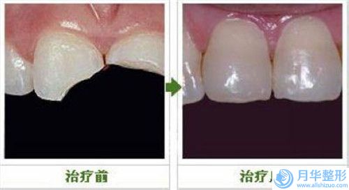 上海九院醫(yī)療整形科雙臂抽脂手術(shù)效果好又便宜